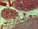 Thymus of a child